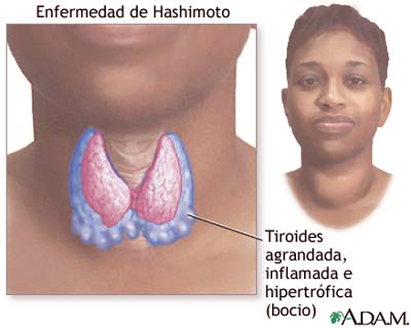 tiroides-01